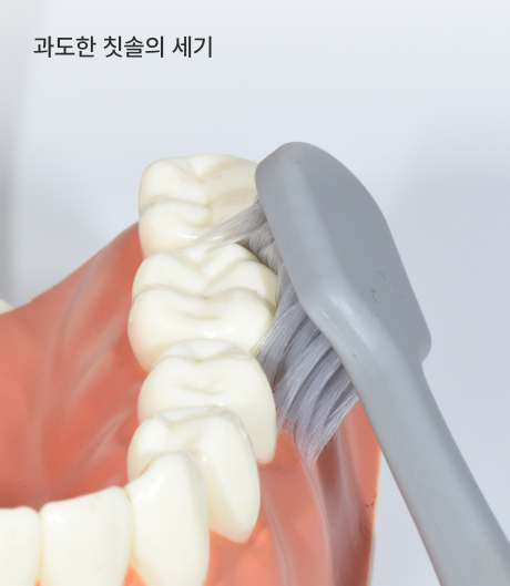 올바른 양치법 과도한 칫솔 세기