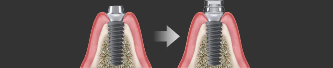 더스퀘어치과 | 앞니 임플란트 - 하이니스 원데이 임플란트 과정