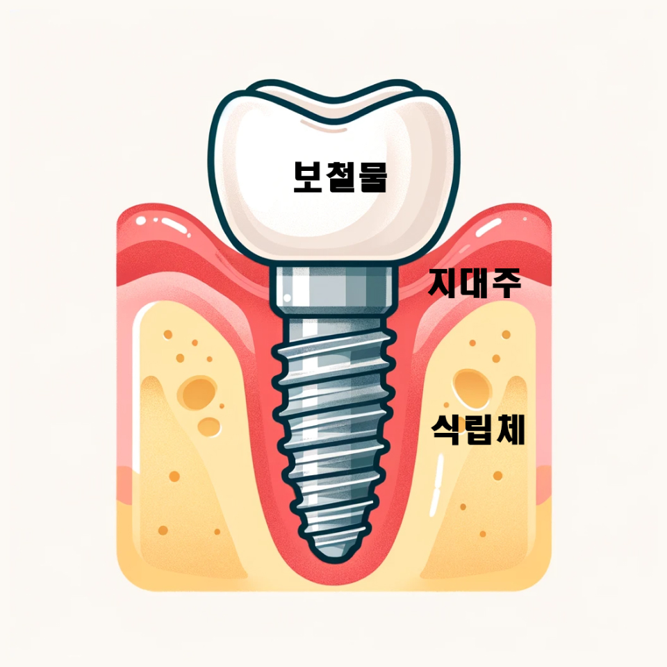 더스퀘어치과 | 임플란트 구조