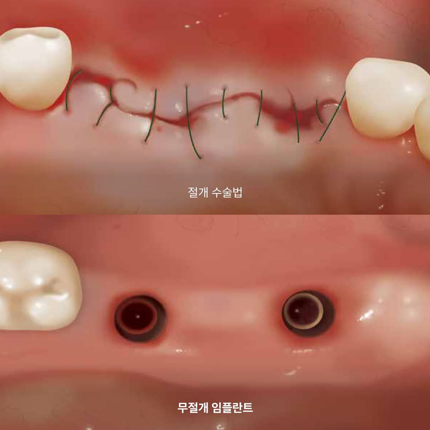 더스퀘어치과 | 무절개 임플란트