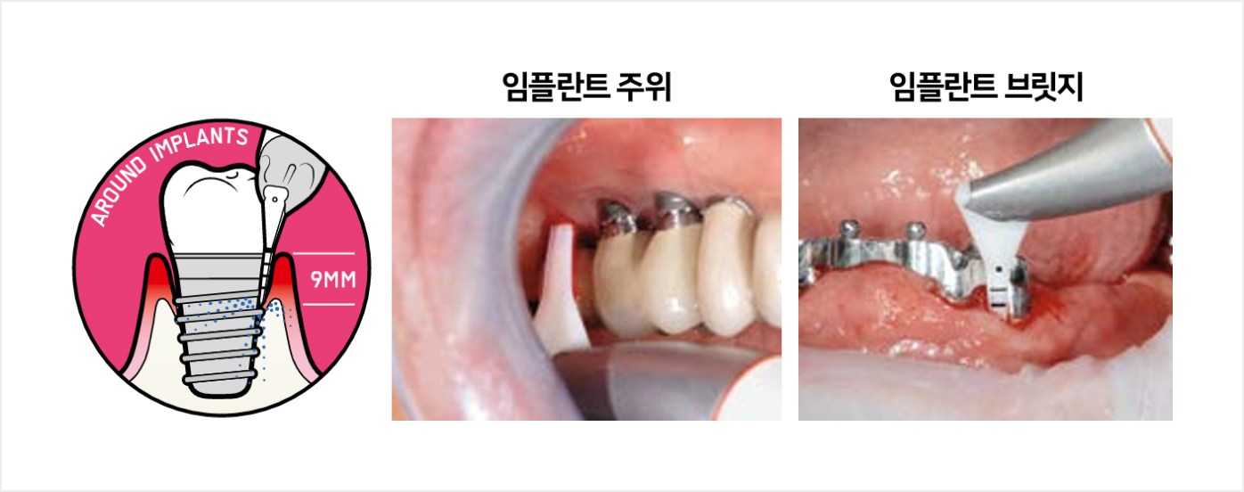 더스퀘어치과 | 임플란트 주위염 치료 방법 더스퀘어 딥스파 시행
