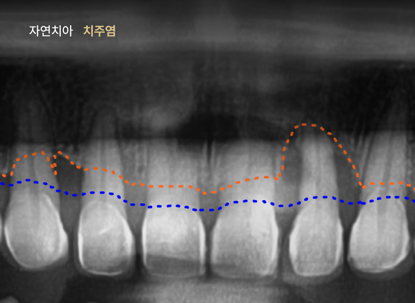 더스퀘어치과 | 임플란트 관리가 필요한 이유 임플란트 자연치아 치주염