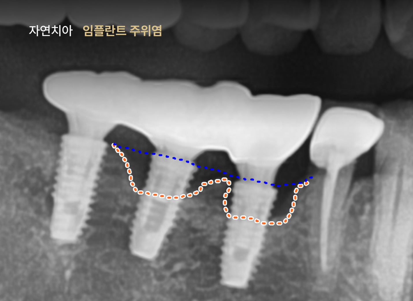 더스퀘어치과 | 임플란트 관리가 필요한 이유 임플란트 자연치아 주위염