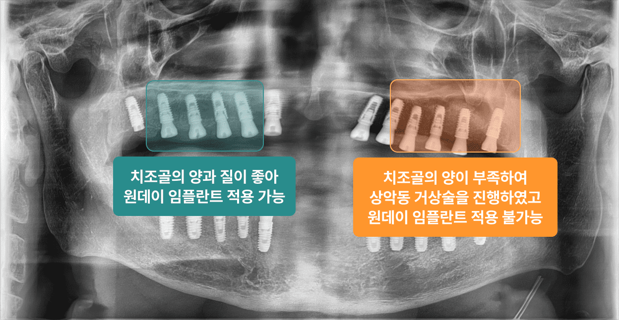 더스퀘어치과 | 원데이 임플란트 조건 01