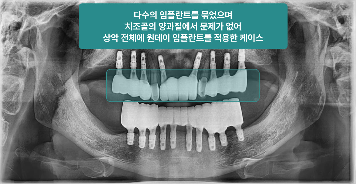 더스퀘어치과 | 원데이 임플란트 조건 02