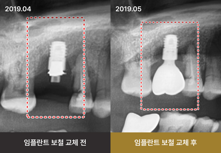 더스퀘어치과 | 임플란트 재수술 - 임플란트 보철 교체하여 재수술을 피한 케이스