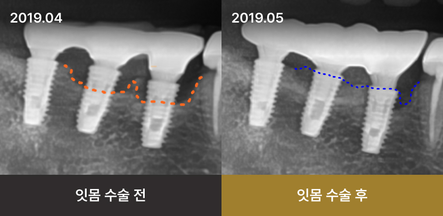 더스퀘어치과 | 임플란트 재수술 - 잇몸 수술을 통해 임플란트 주위염을 해결하고 골재생을 도모한 케이스