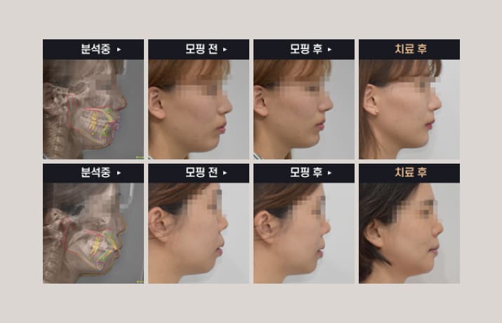더스퀘어치과 | 브라켓 교정 AI 시뮬레이션으로 미리 보는 변화(선택)