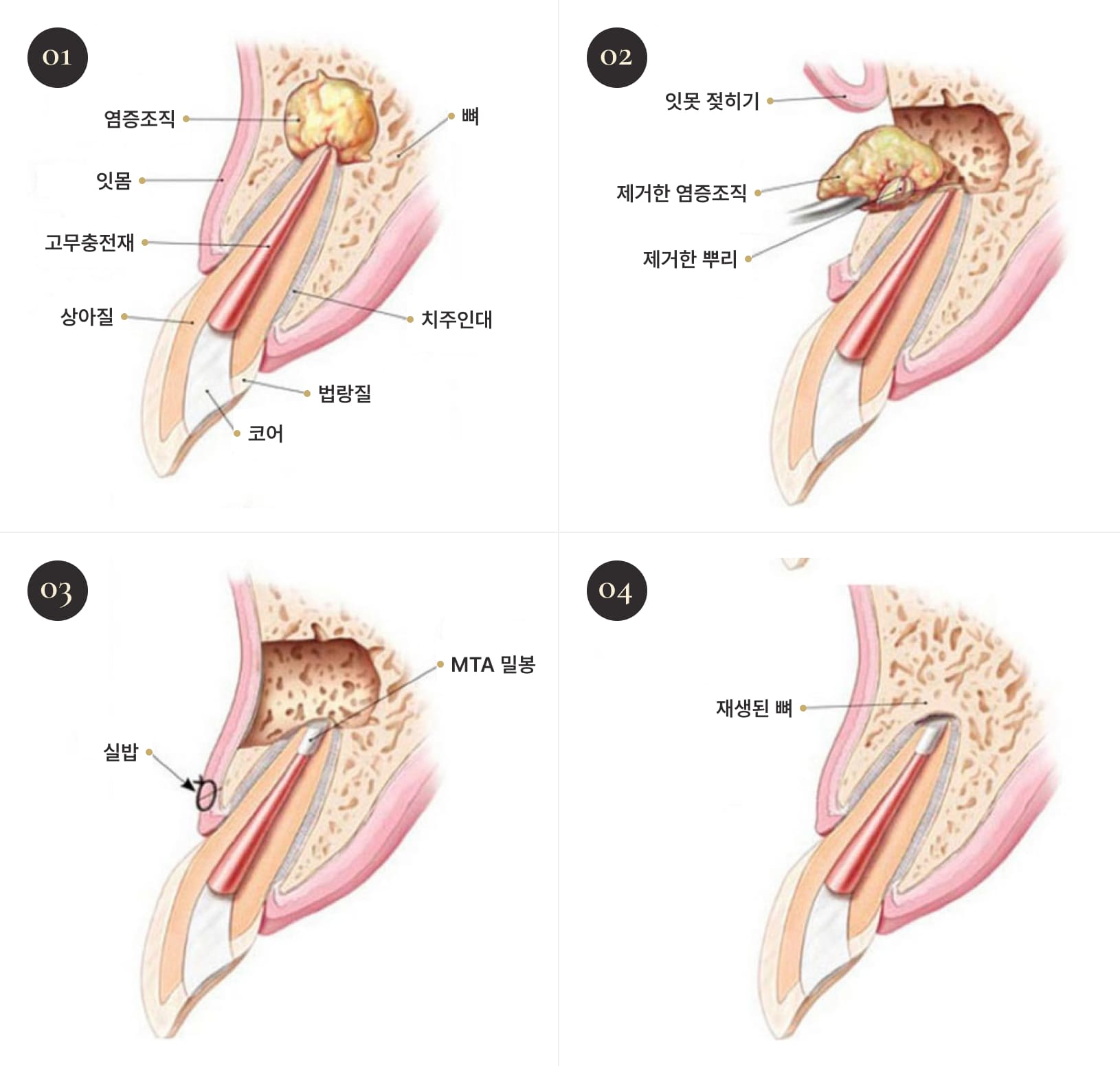 더스퀘어치과 | 더스퀘어치과 치근단 절제술