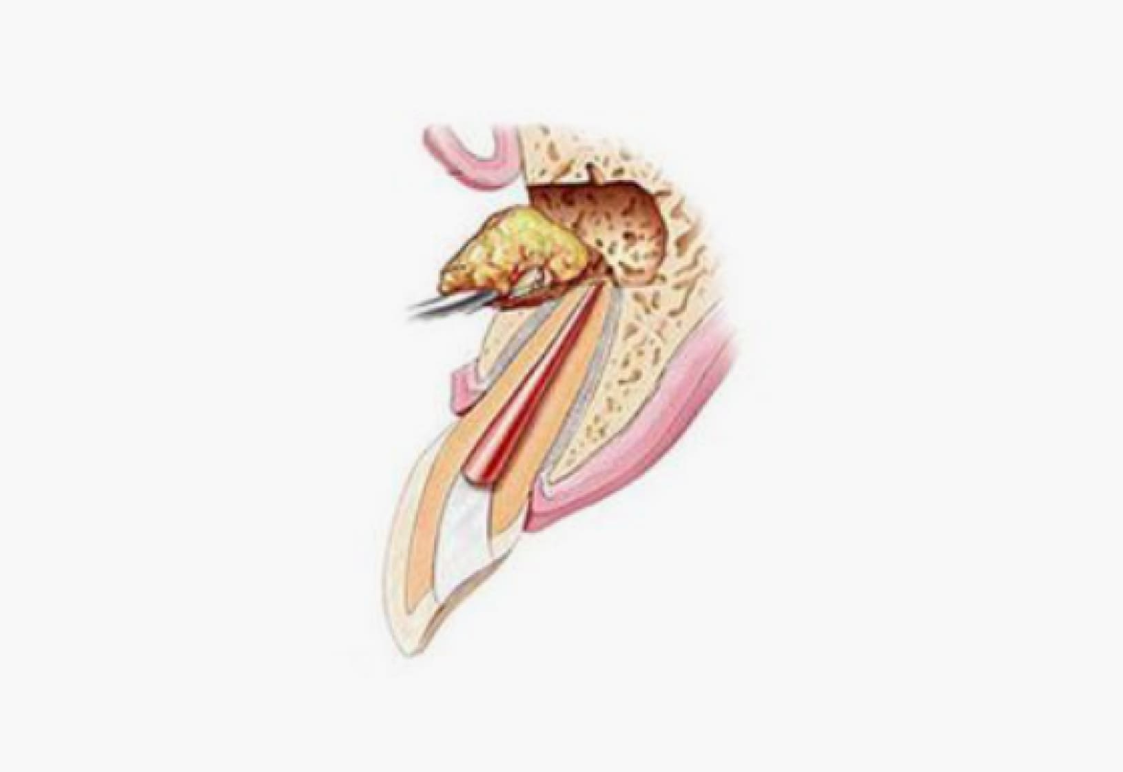 더스퀘어치과 | 단계별 치아살리기 프로젝트 치근단 절제술