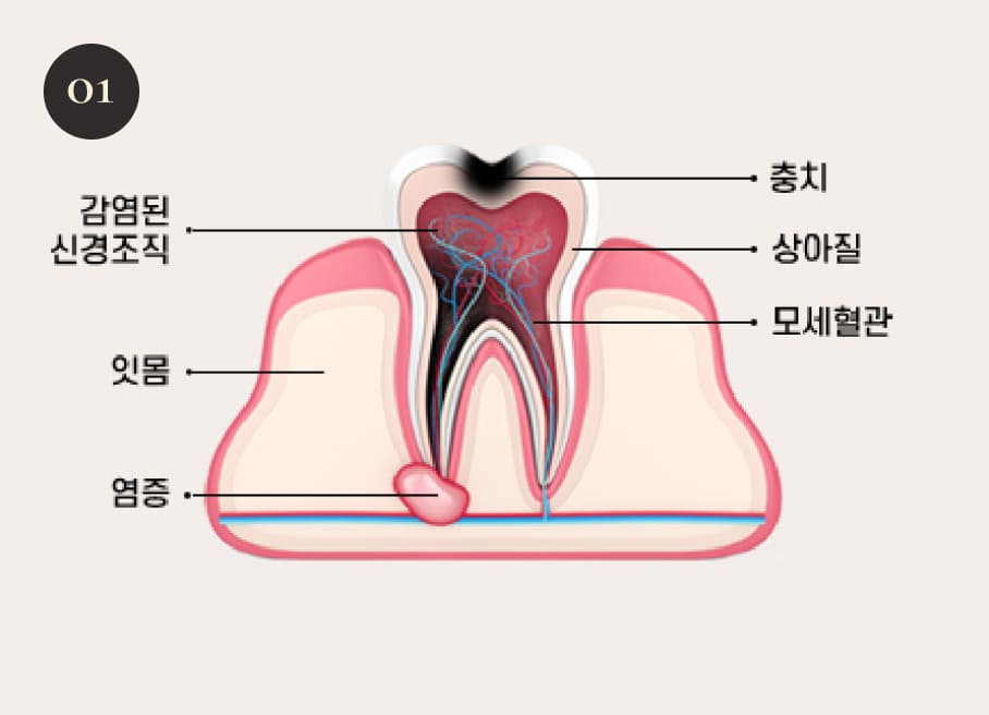 더스퀘어치과 | 더스퀘어치과 신경치료 과정