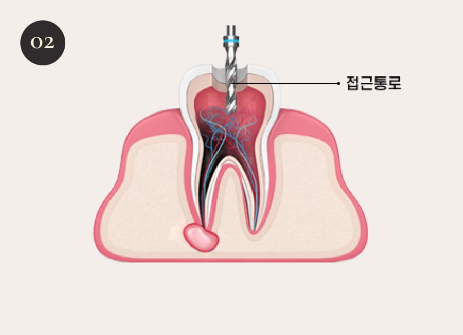 더스퀘어치과 | 더스퀘어치과 신경치료 과정