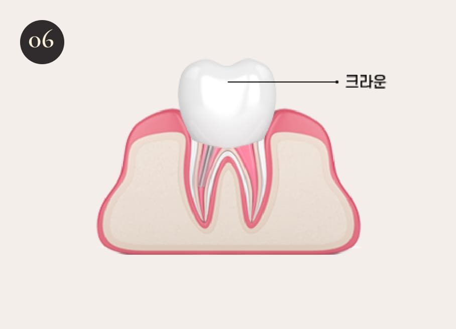 더스퀘어치과 | 더스퀘어치과 신경치료 과정