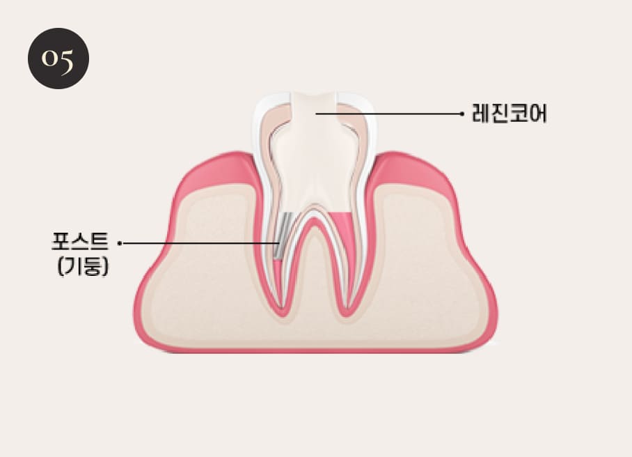 더스퀘어치과 | 더스퀘어치과 신경치료 과정