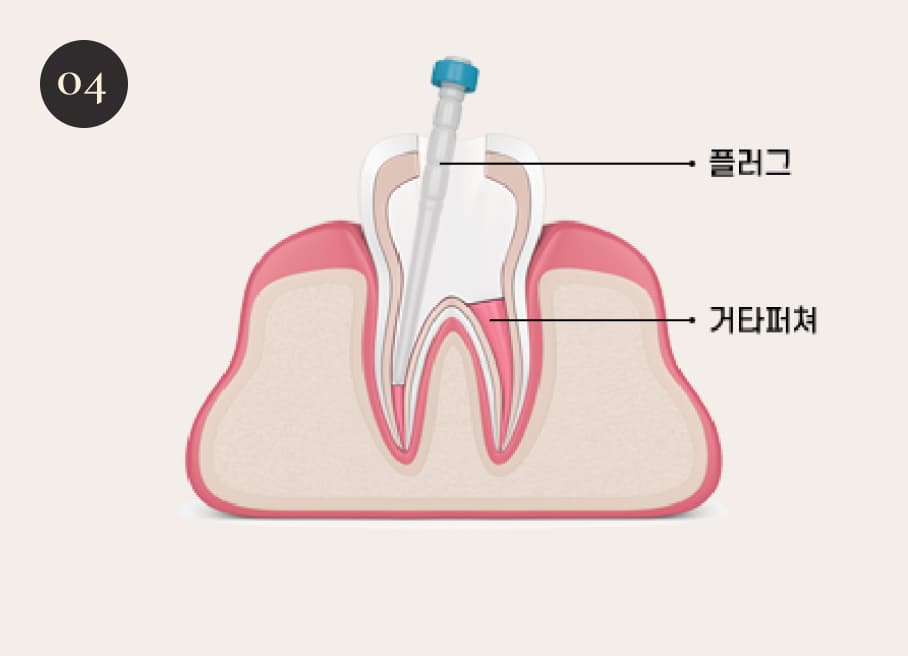더스퀘어치과 | 더스퀘어치과 신경치료 과정