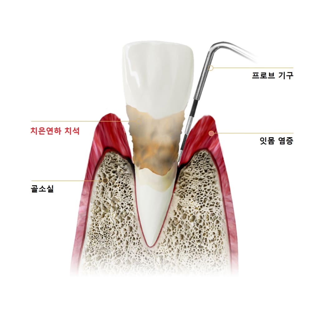 더스퀘어치과 | 치주과 잇몸 치료
