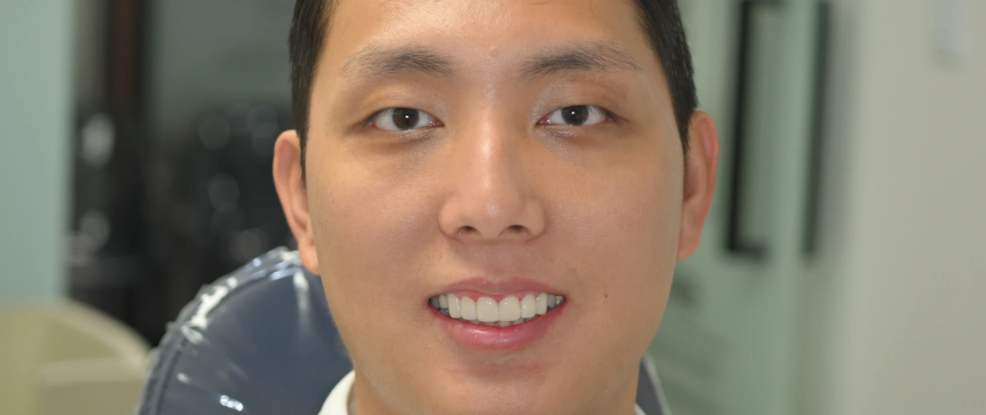 더스퀘어치과 | 미니쉬 하이브리드 전후사진 후