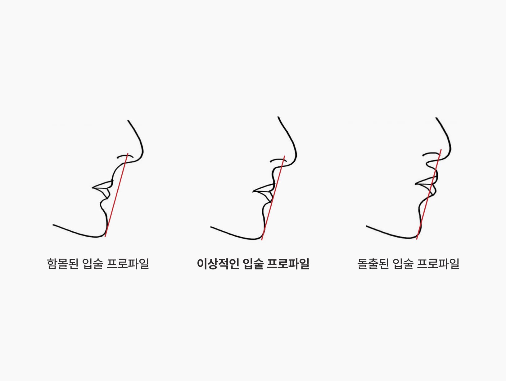 더스퀘어치과 | 더스퀘어치과의 얼굴 옆모습 개선 입술 및 돌출 지지 개선