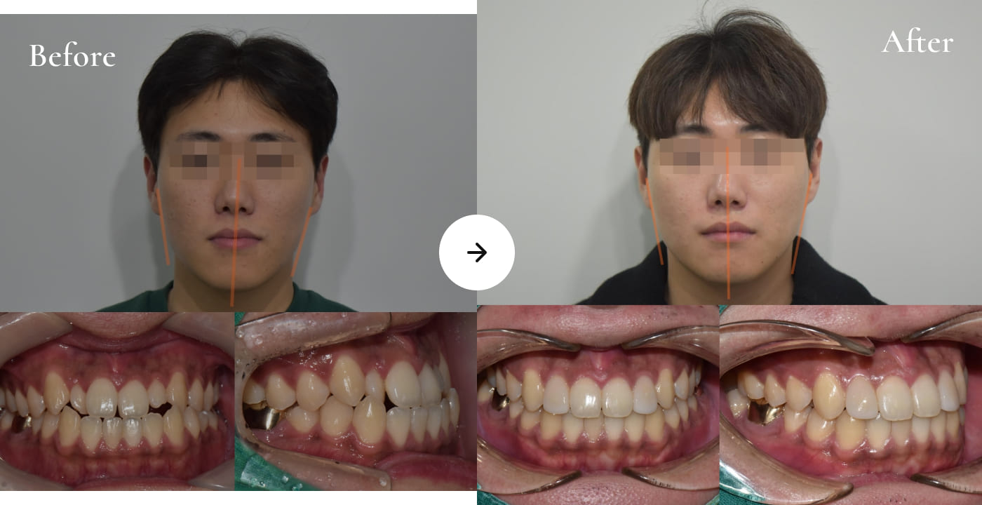 더스퀘어치과 | 정면 프로파일 개선법 교정을 통한 비대칭 개선