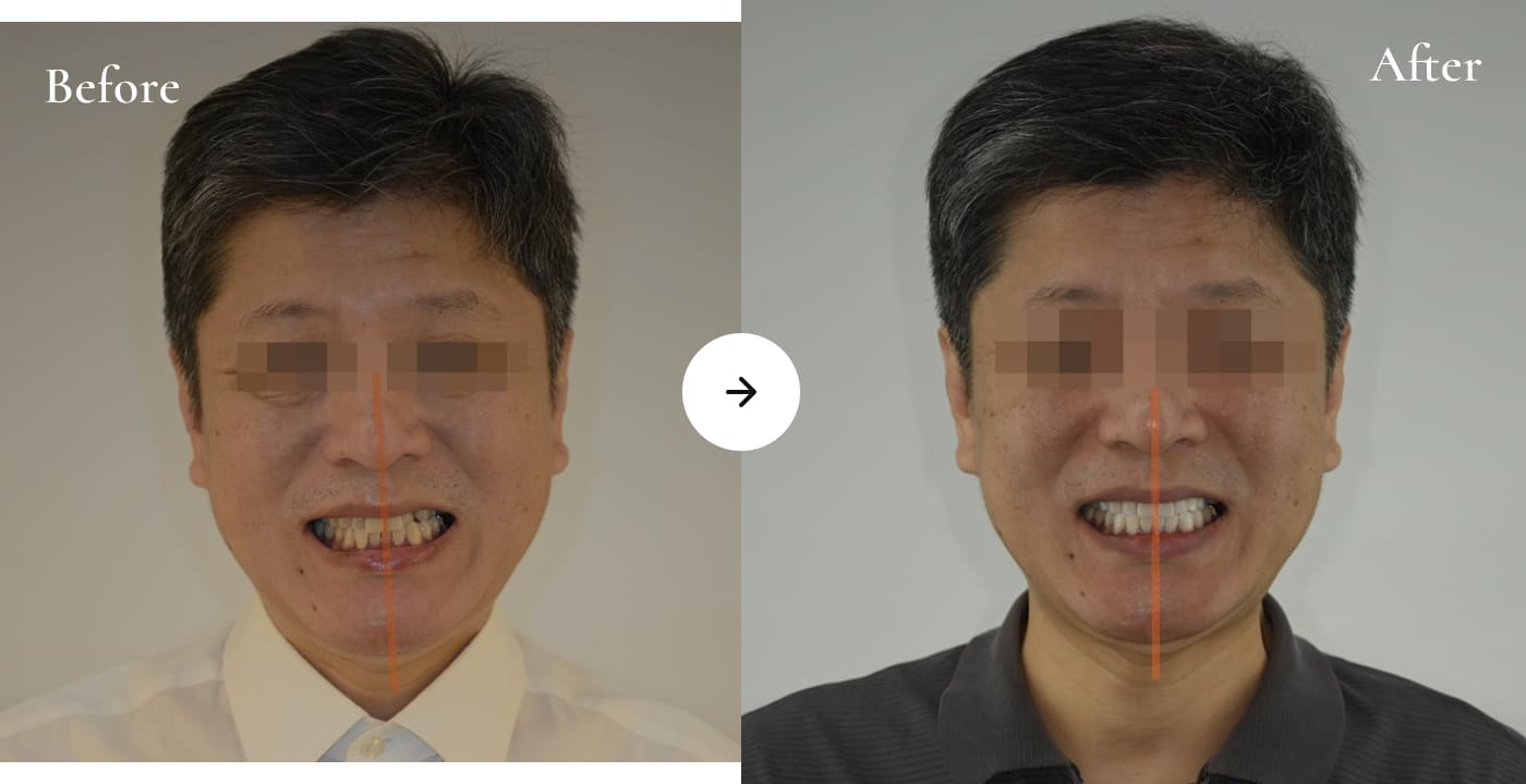 더스퀘어치과 | 정면 프로파일 개선법 치아성형을 통한 비대칭 개선