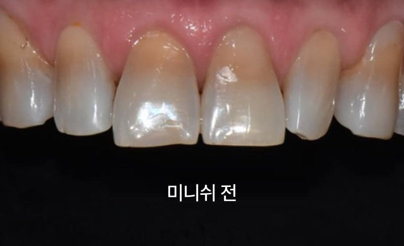 더스퀘어치과 | 미니쉬 하이브리드 솔루션