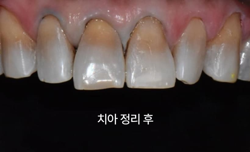 더스퀘어치과 | 미니쉬 하이브리드 솔루션