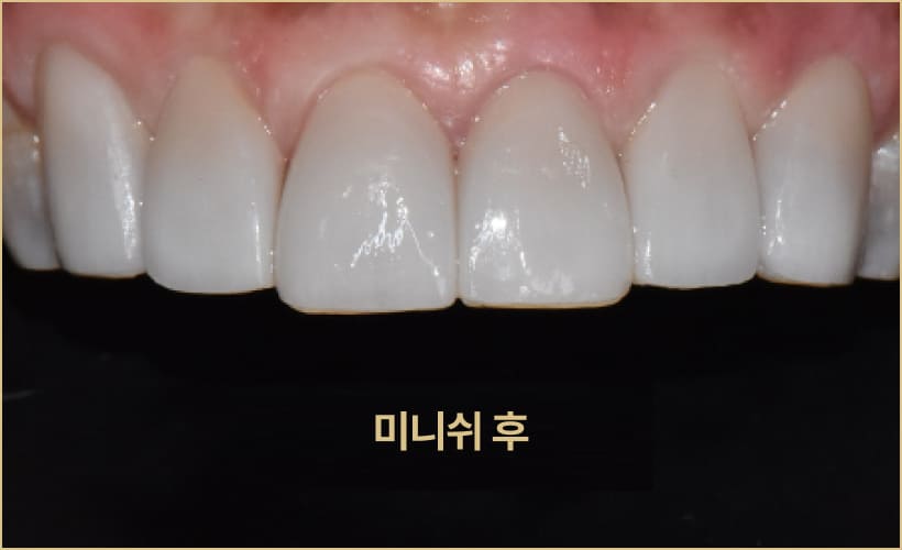 더스퀘어치과 | 미니쉬 하이브리드 솔루션