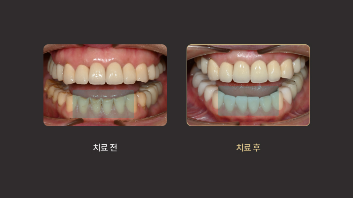 더스퀘어치과 | 미니쉬 에버 치아 노화 해결 치아 교모