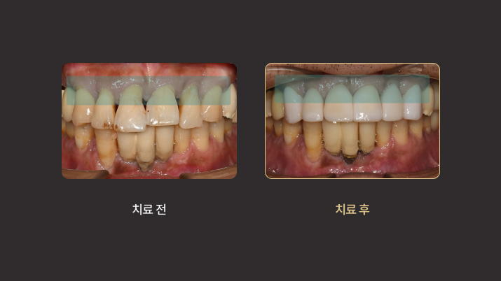 더스퀘어치과 | 미니쉬 에버 치아 노화 해결 잇몸 퇴축