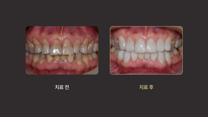 더스퀘어치과 | 미니쉬 에버 치아 노화 해결 치경부 마모증