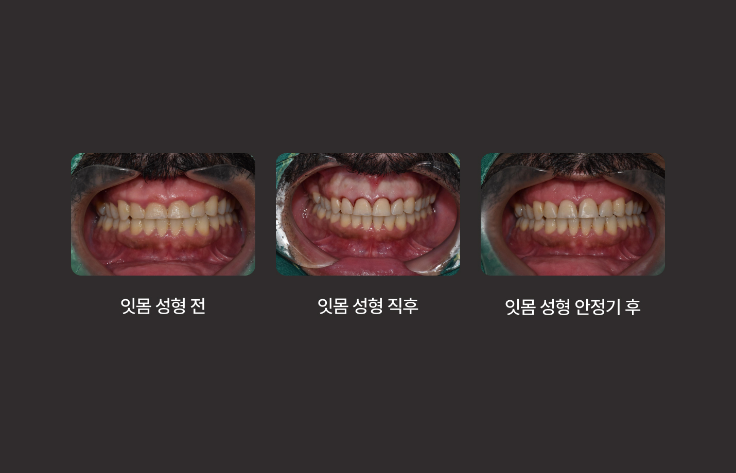 더스퀘어치과 | 잇몸성형 언제 필요 잇몸이 이를 과도하게 덮고 있는 경우