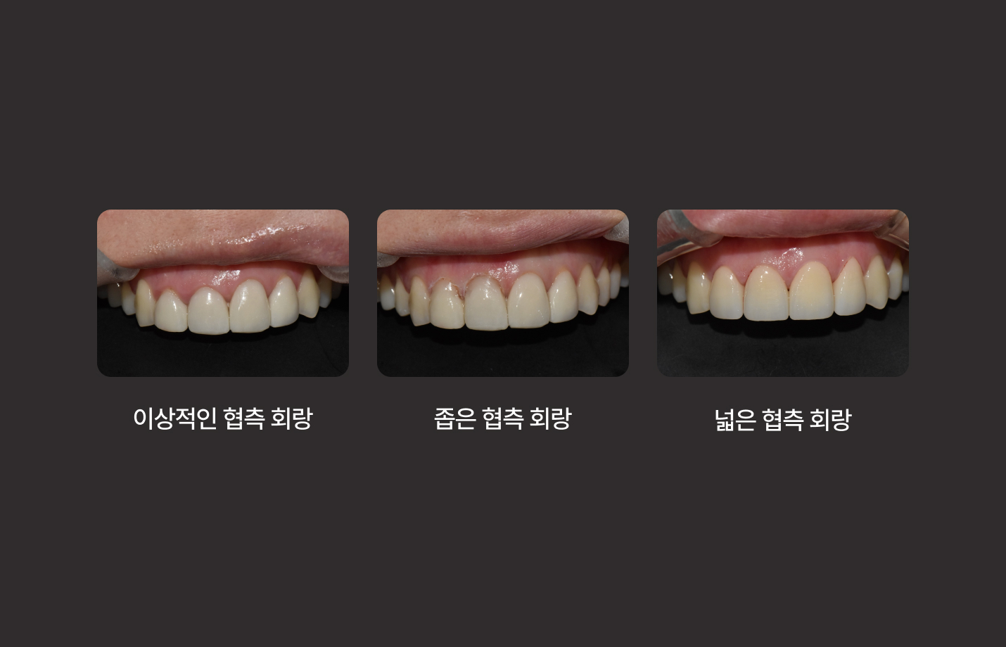 더스퀘어치과 | 잇몸성형 언제 필요 잇몸 모양의 좌우 대칭성이 맞지 않는 경우