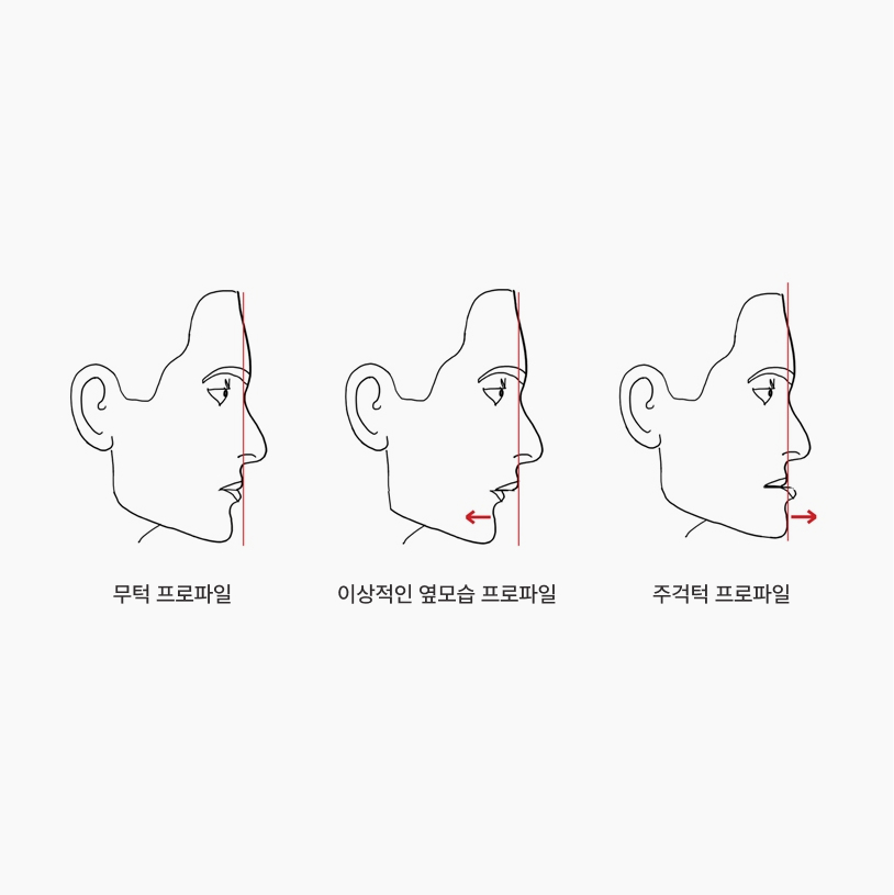더스퀘어치과 | 더스퀘어치과의 얼굴 옆모습 개선