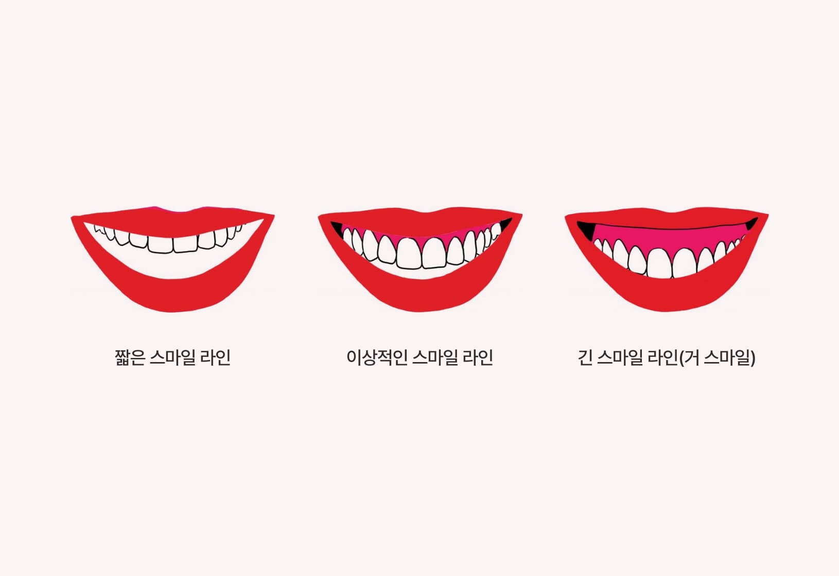 더스퀘어치과 | 스마일 아크의 수직적 위치