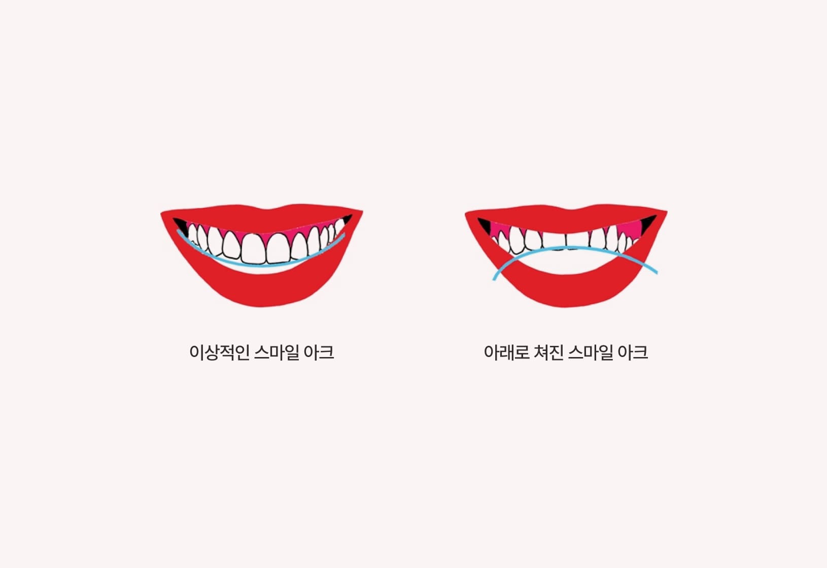 더스퀘어치과 | 스마일 아크의 형태