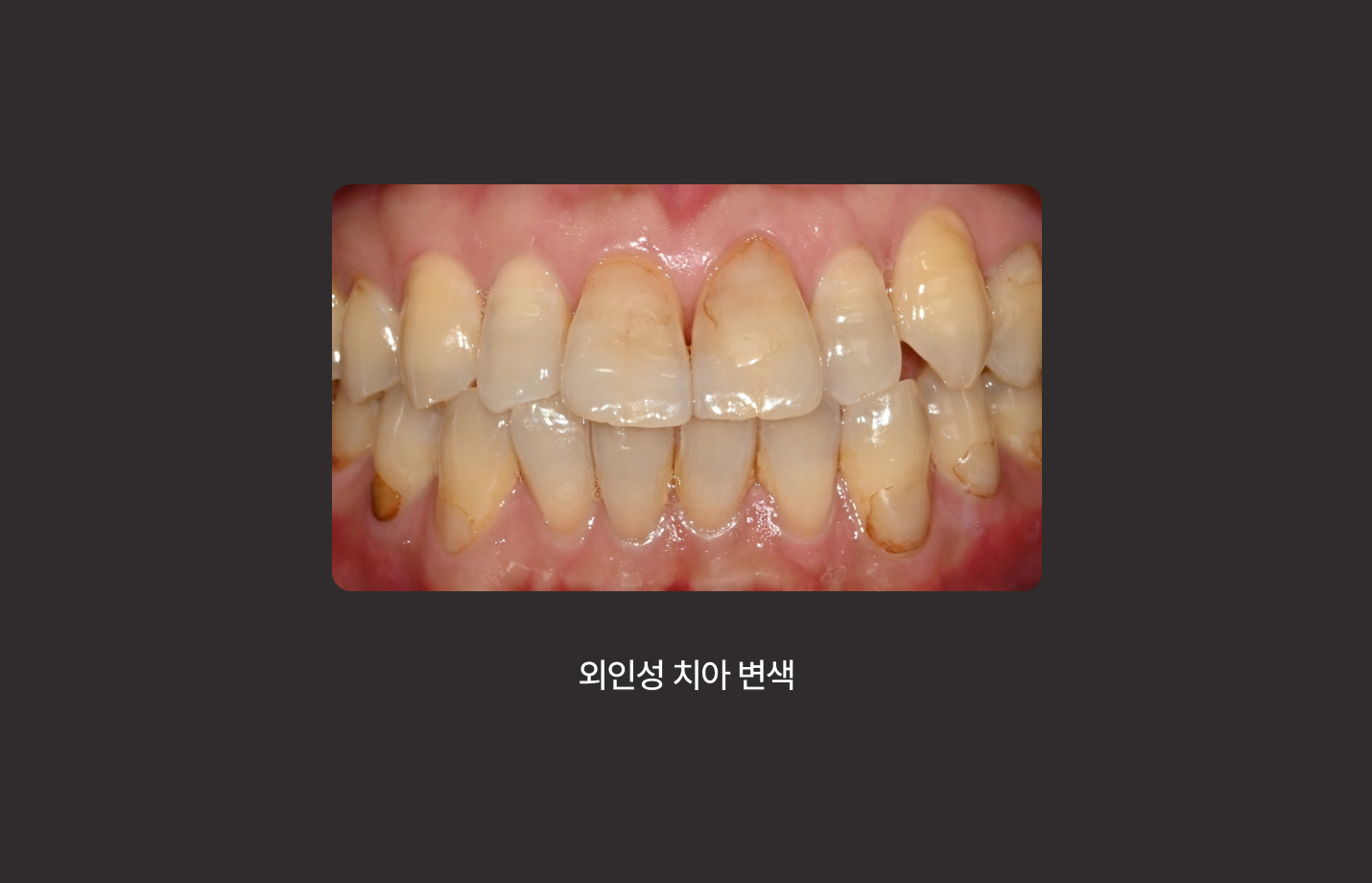 더스퀘어치과 | 치아 변색 원인 외인성
