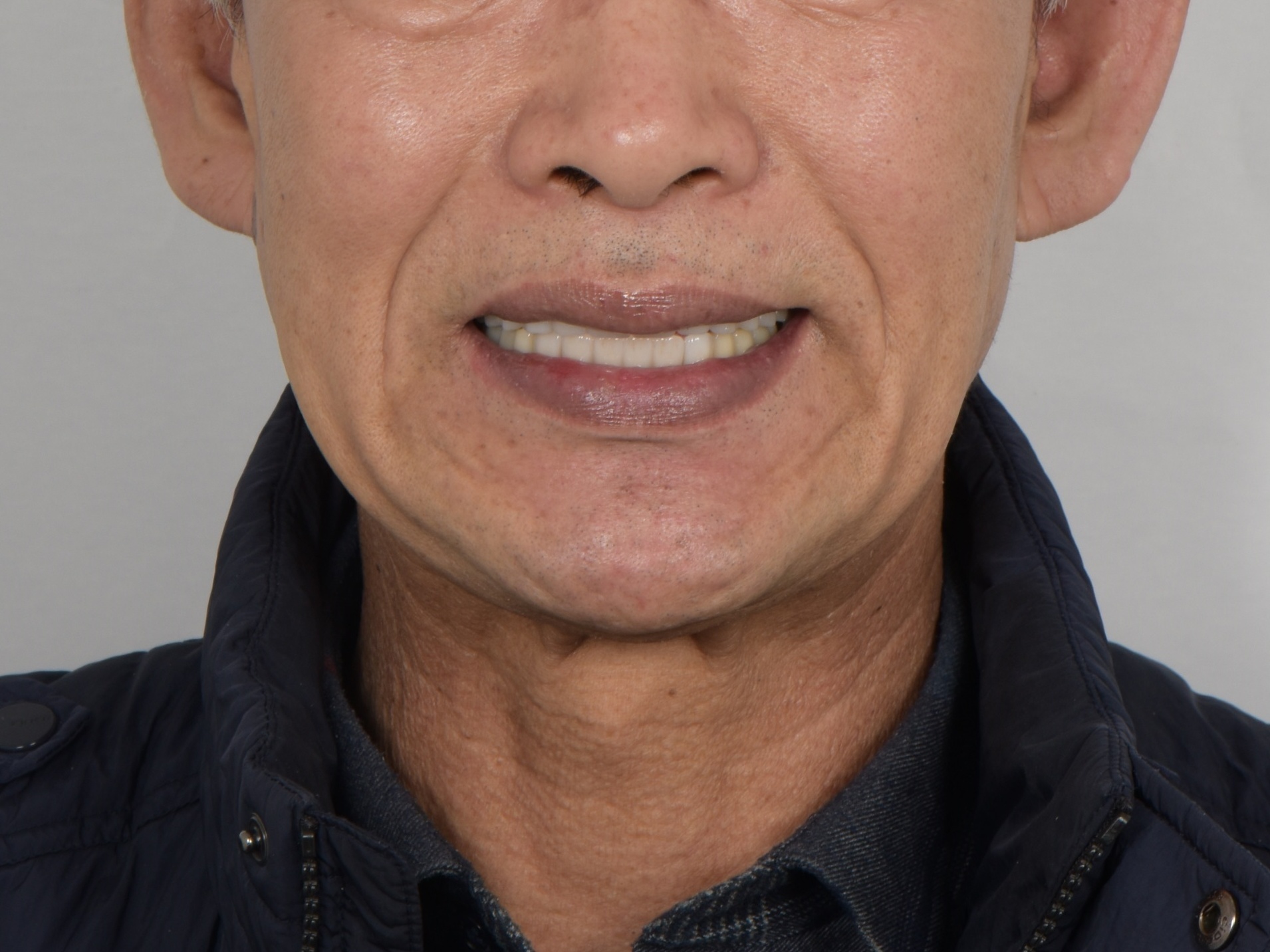 광화문치과 전체 임플란트를 통한 기능 재건