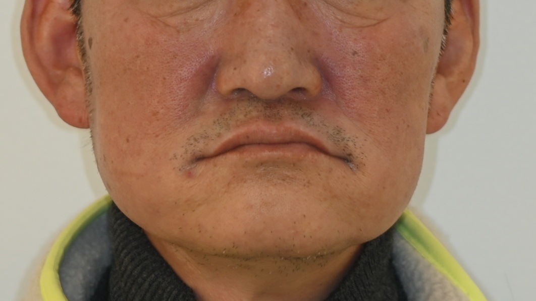 편악 임플란트를 통한 안모개선