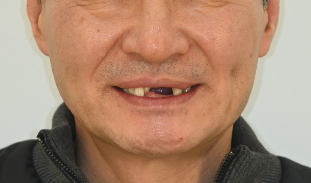 상실된 다수치, 전체 임플란트로 안모개선 및 교합기능 회복