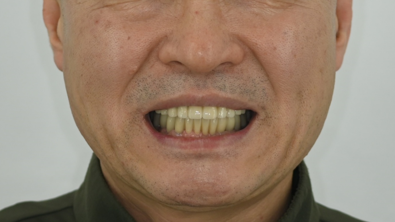 상실된 다수치, 전체 임플란트로 안모개선 및 교합기능 회복