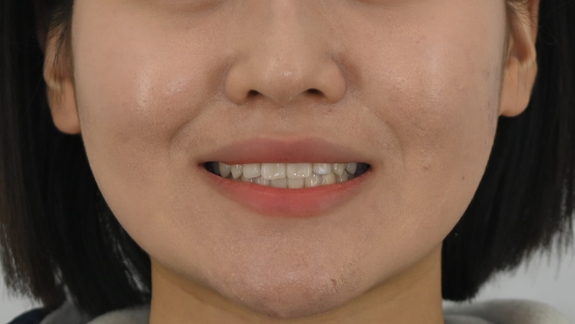 벌어진치아교정