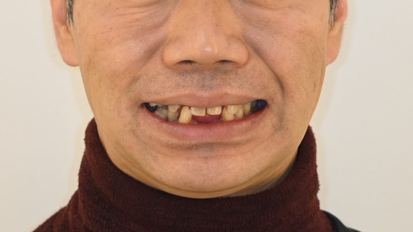 잇몸(치주) 질환으로 인한 다수치 상실, 임플란트로 교합 재건  