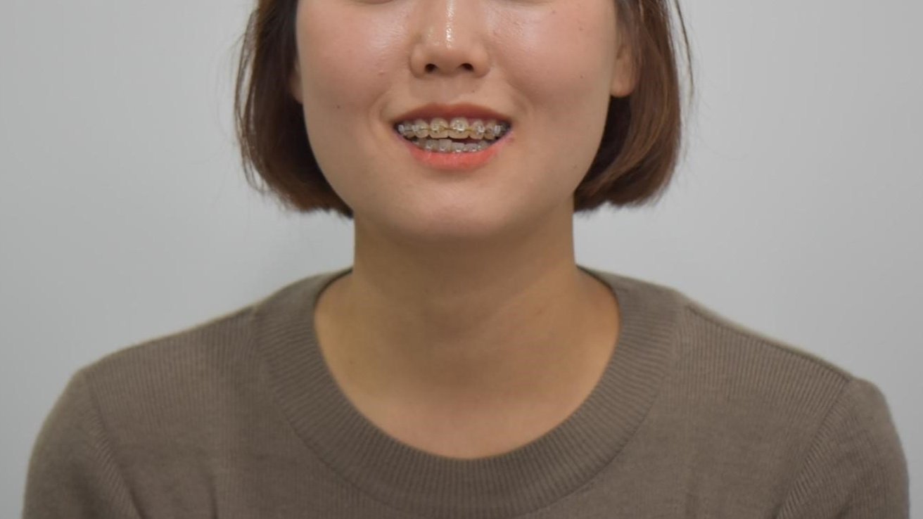 인비절라인 재교정