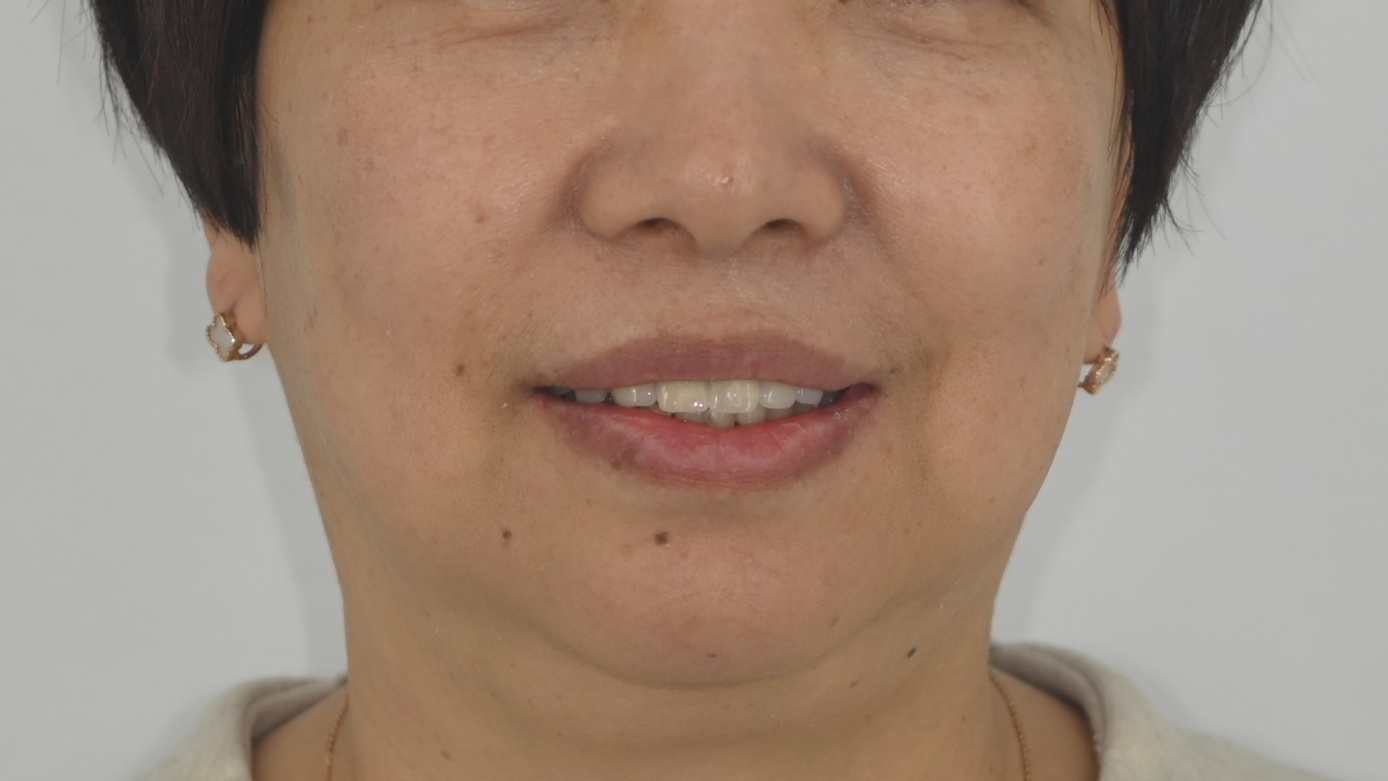 윗턱 앞니 치간이개, 심미 임플란트 